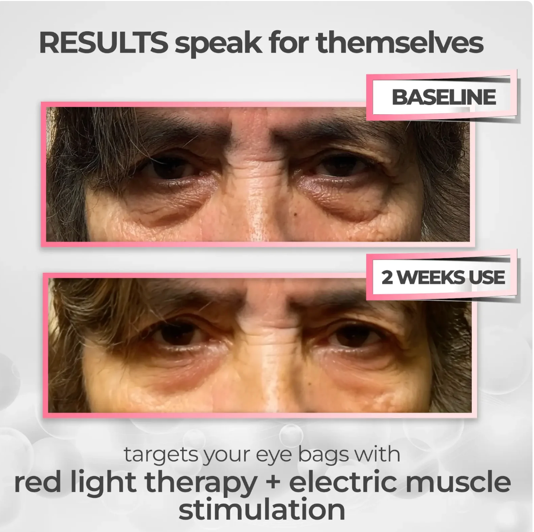 EyeLume™ Pro – 2-in-1 Eye Renewal Device