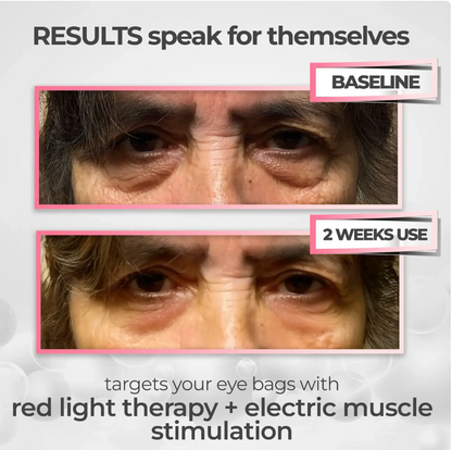 EyeLume™ Pro – 2-in-1 Eye Renewal Device