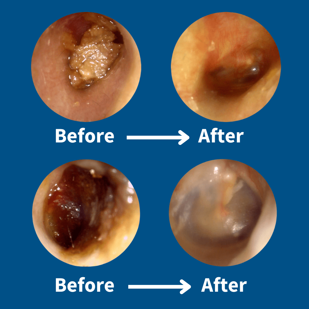 SafeEar™ Wax Removal Cam-Kit