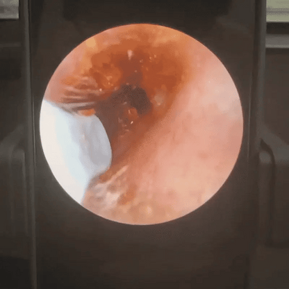 SafeEar™ Wax Removal Cam-Kit